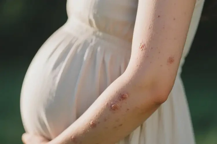 產(chǎn)婦手臂上偶爾起濕疹可不可以徹底自愈(圖2)