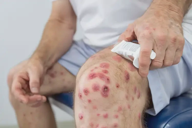 男人四肢出現(xiàn)濕疹不管它會(huì)自己好嗎(圖2)