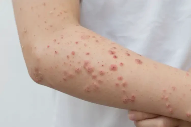 青少年手臂上經(jīng)常長(zhǎng)濕疹不管它會(huì)自己好嗎(圖4)