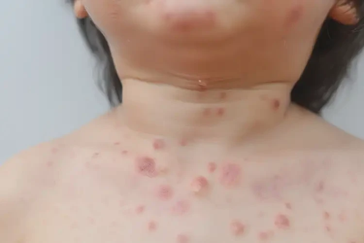 少兒脖子上容易起濕疹能徹底自愈嗎(圖4)