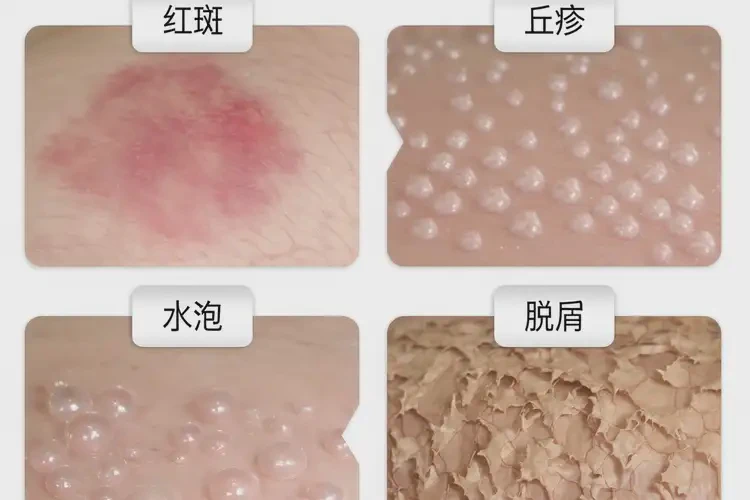 男性屁股起濕疹不管它會自己痊愈嗎(圖1)