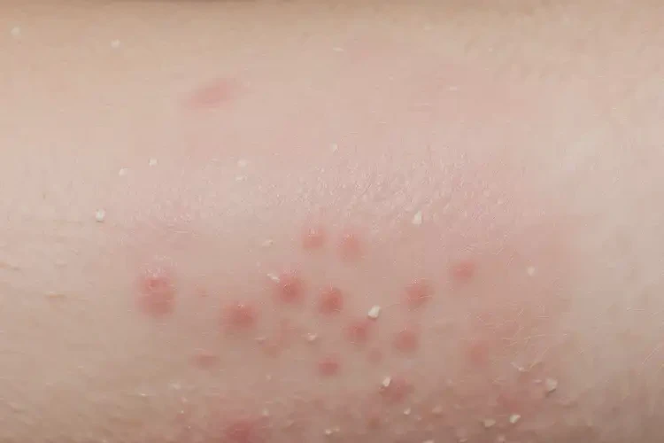 女性全身偶爾長(zhǎng)濕疹不管它會(huì)自己好嗎(圖4)