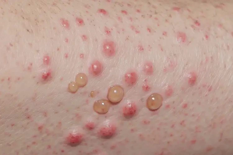 女生臉上出濕疹不管它會(huì)自己好嗎(圖4)