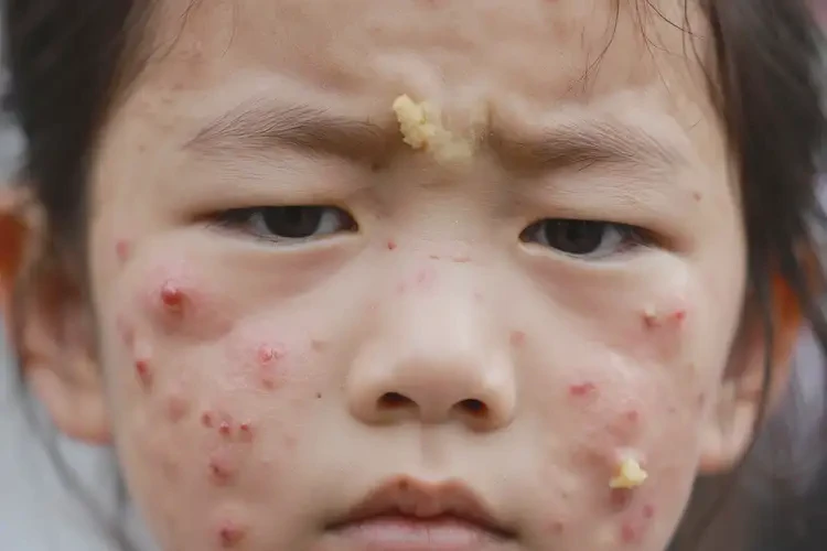 小兒臉上經(jīng)常長濕疹不管它會自己好嗎(圖4)