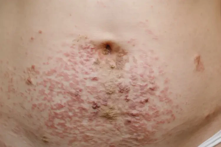 女性肚子上出濕疹可不可以徹底自愈(圖2)