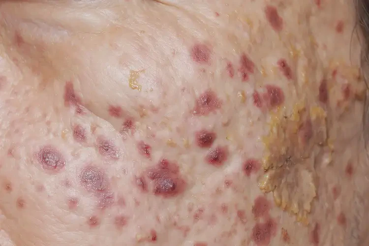 女性全身偶爾長(zhǎng)濕疹不管它會(huì)自己好嗎(圖2)