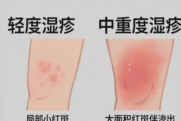 女性大腿上容易起濕疹能靠自己自愈嗎(圖3)