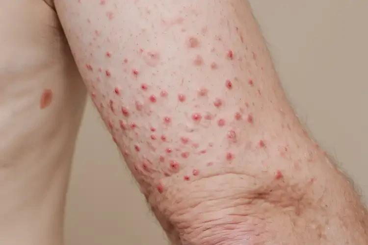 男人全身長(zhǎng)濕疹能徹底自愈嗎(圖4)