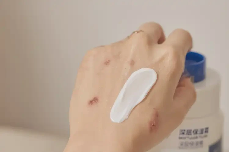 男人手上出現(xiàn)濕疹不管它會自己自愈嗎(圖2)