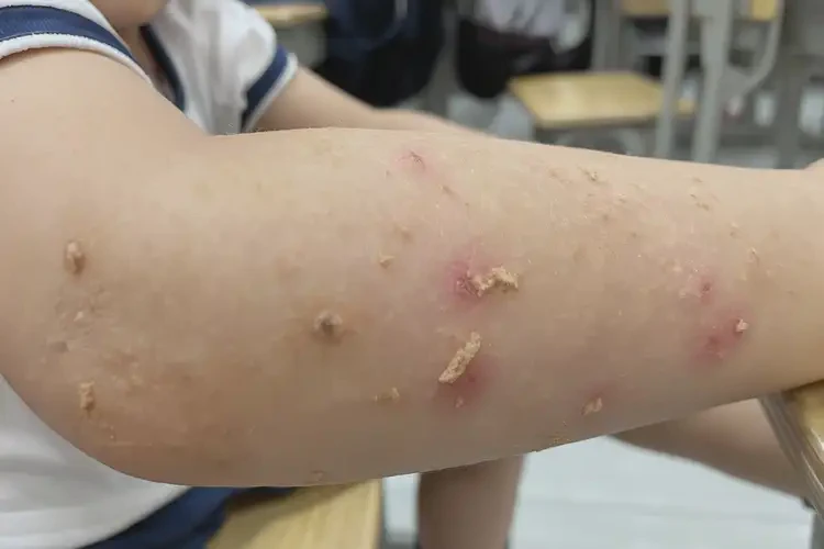 小学生四肢出湿疹能不能彻底自愈(图4)