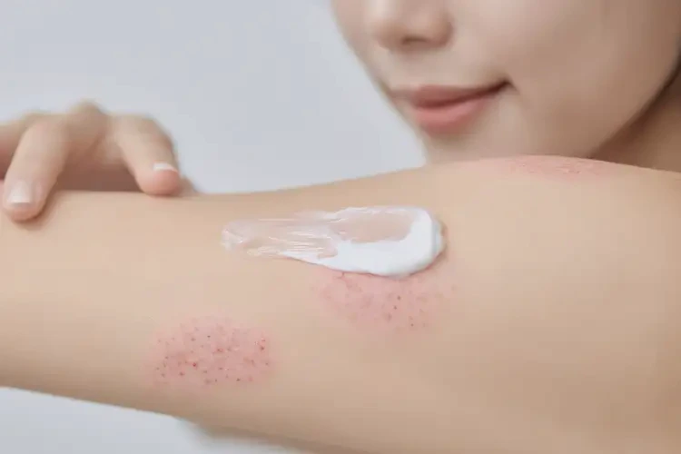 女生手臂有湿疹能彻底自愈吗(图3)