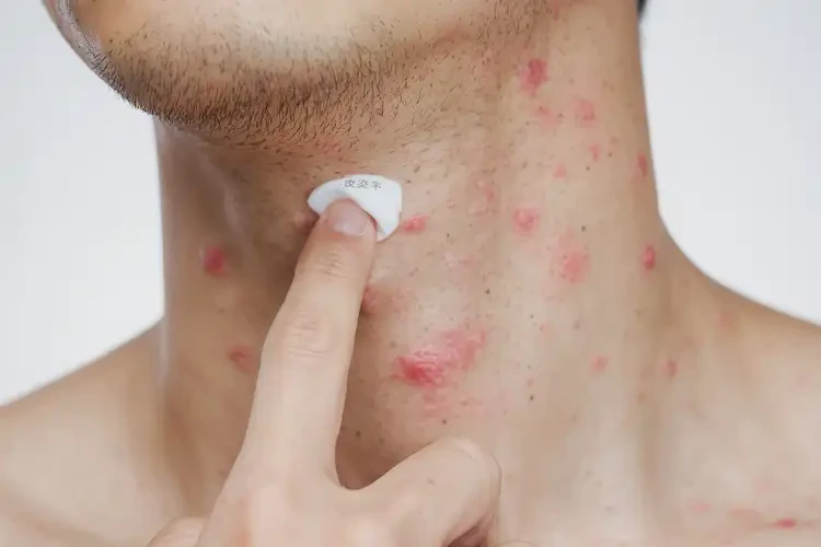 青年人脖子经常长湿疹能够彻底治愈吗(图4)