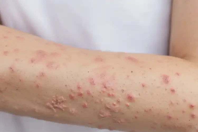 女生四肢容易起濕疹可以徹底自愈嗎(圖4)