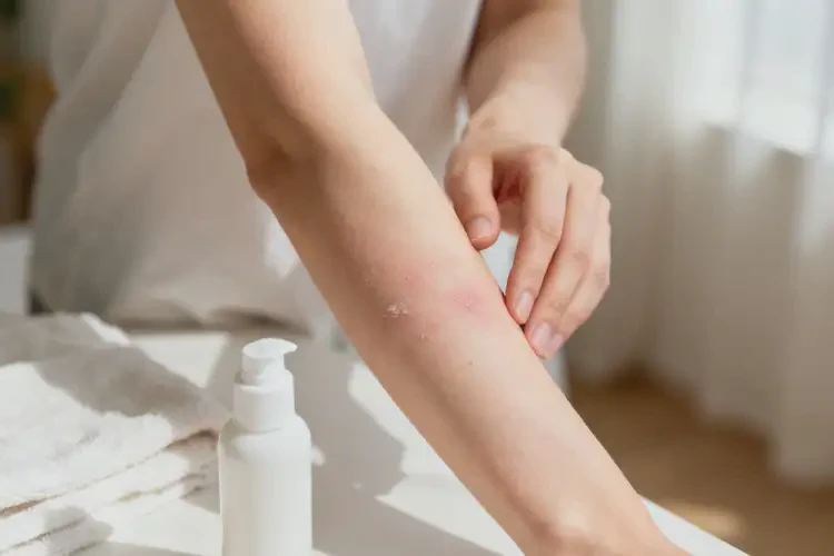 女生手臂長濕疹能靠自己自愈嗎(圖1)