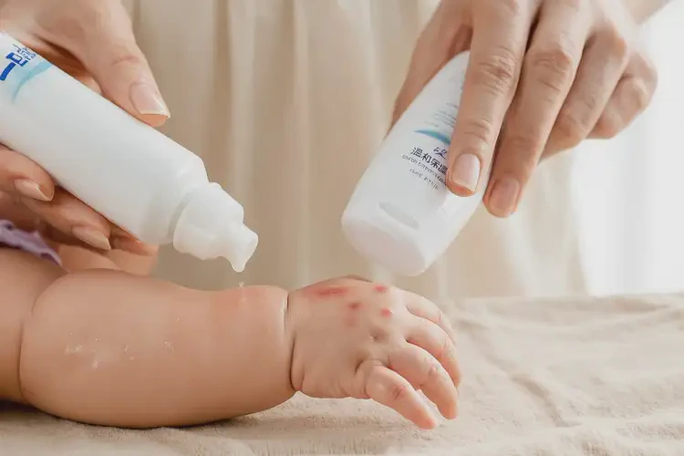 嬰兒手臂長濕疹可以徹底自愈嗎(圖3)