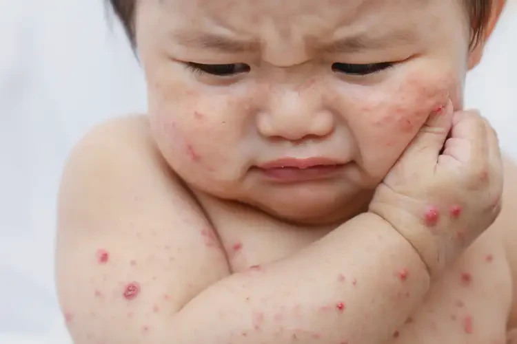 小孩屁股上有濕疹能徹底自愈嗎(圖4)