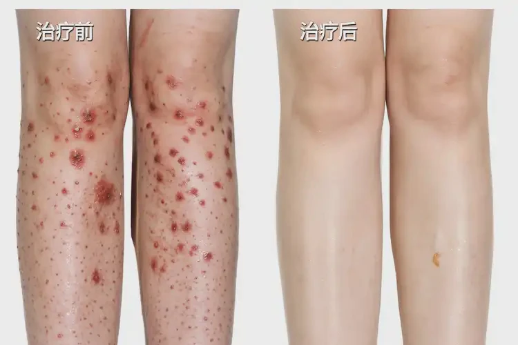 中學(xué)生小腿上經(jīng)常起濕疹可以徹底自愈嗎(圖2)