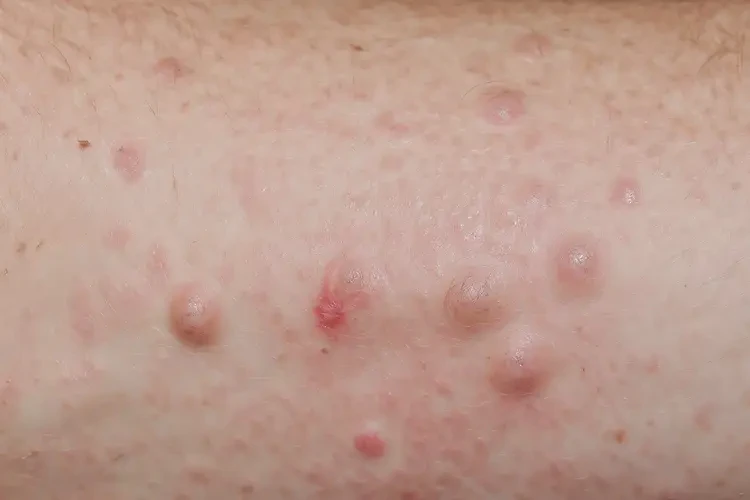 男性全身偶爾長濕疹不管它會(huì)自己好嗎(圖4)