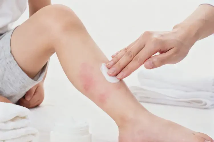 少兒手臂經(jīng)常起濕疹能靠自己自愈嗎(圖4)