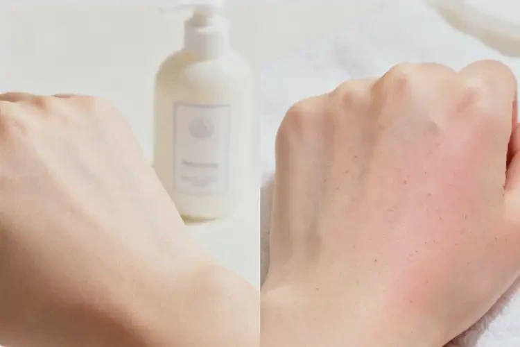 女人身上起濕疹不管它會自己痊愈嗎(圖4)