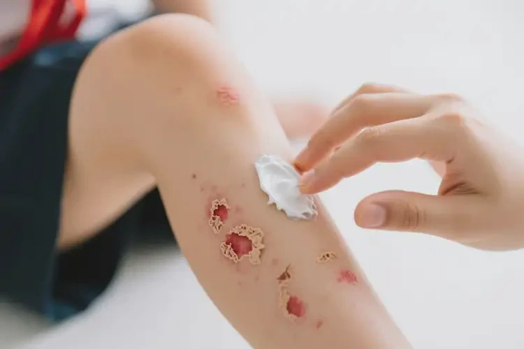 小學生大腿上偶爾長濕疹能夠徹底治愈嗎(圖4)