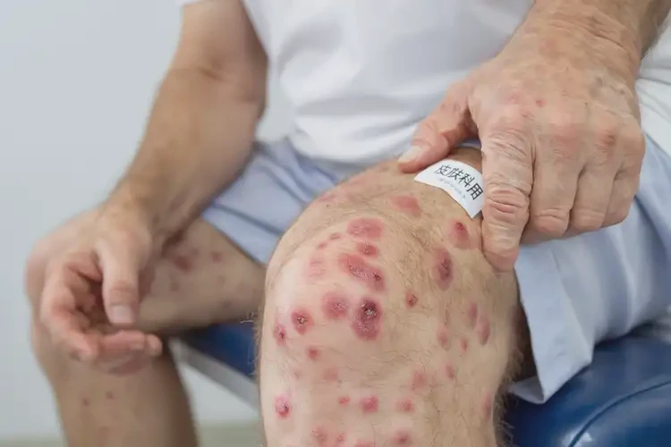 男人四肢出現(xiàn)濕疹不管它會(huì)自己好嗎(圖4)