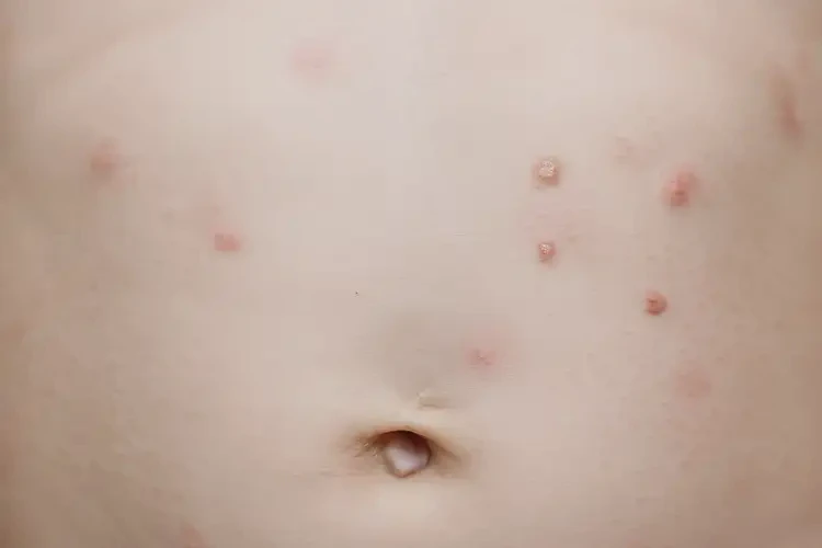 幼兒肚子出現(xiàn)濕疹能靠自己自愈嗎(圖4)