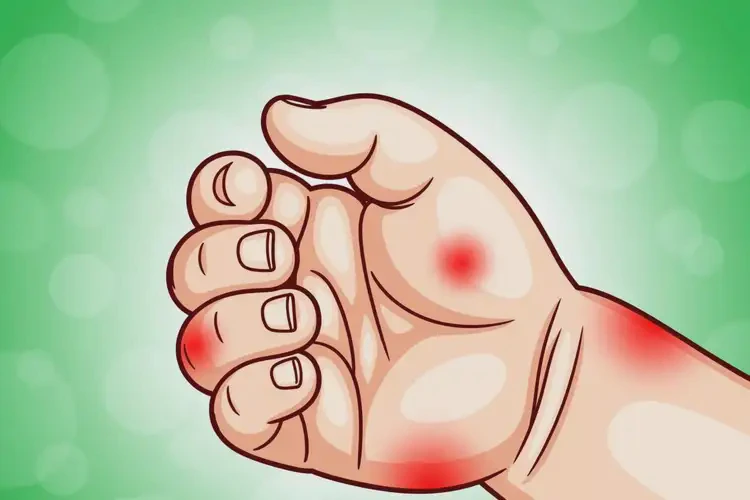 寶寶手上長濕疹不管它會(huì)自己痊愈嗎(圖2)