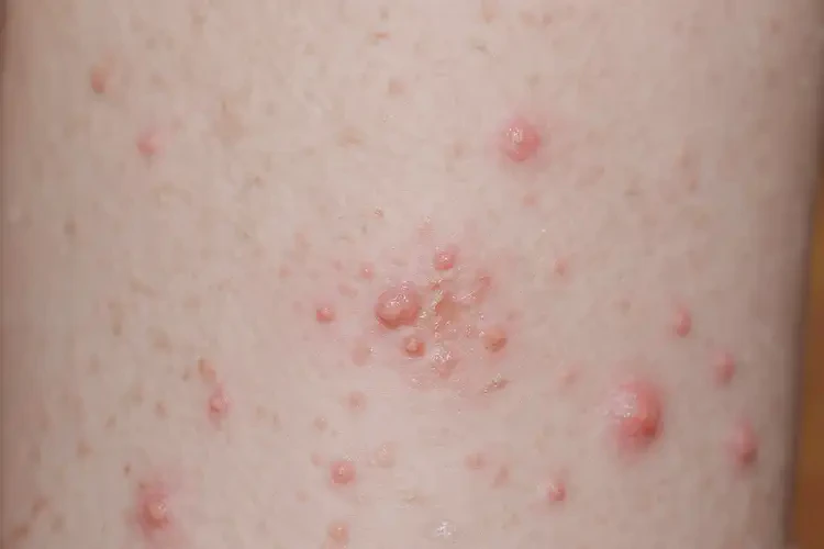 孩子四肢出濕疹可以徹底自愈嗎(圖4)