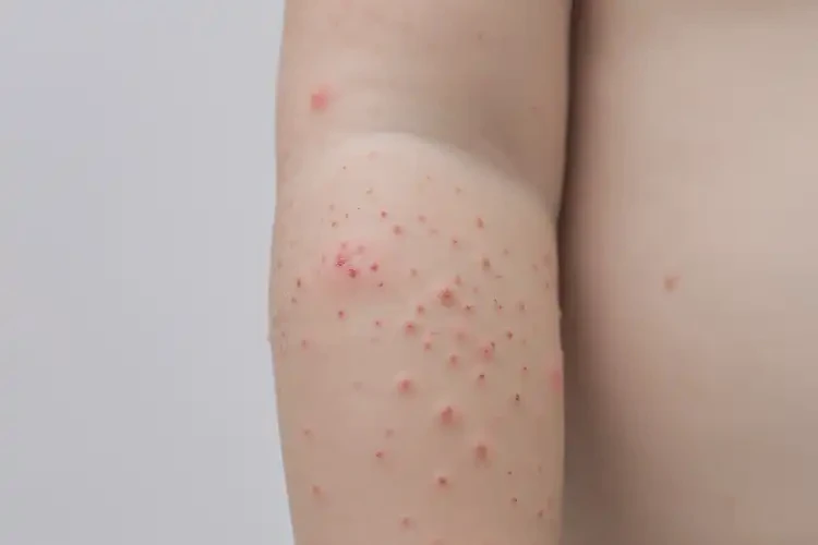 小孩手臂上出现湿疹不管它会自己自愈吗(图2)