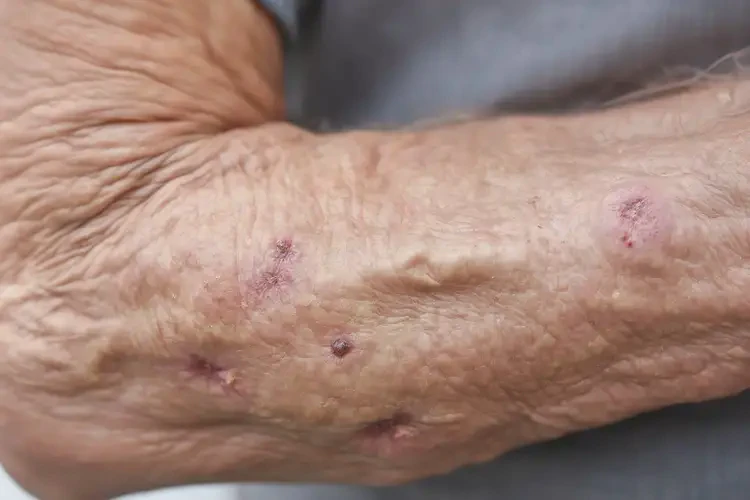 高齡老人手臂出現(xiàn)濕疹能夠徹底治愈嗎(圖4)