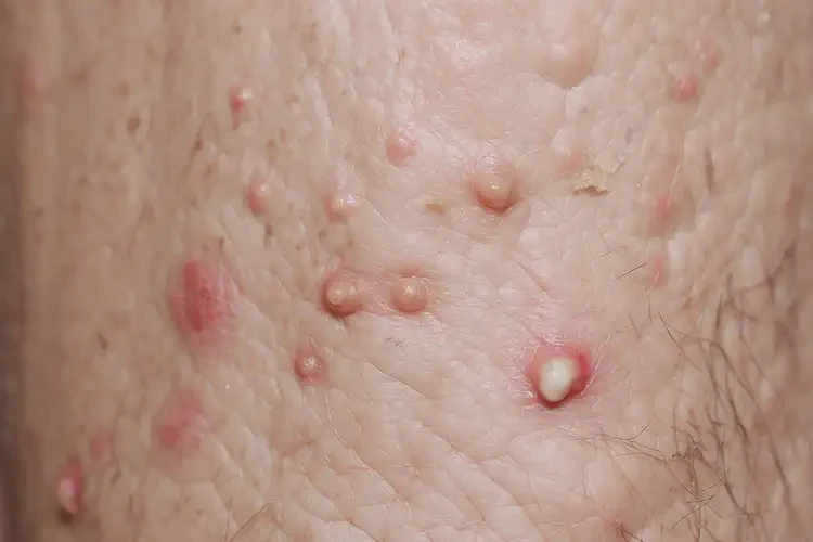 高龄老人小腿容易长湿疹能不能彻底自愈(图4)