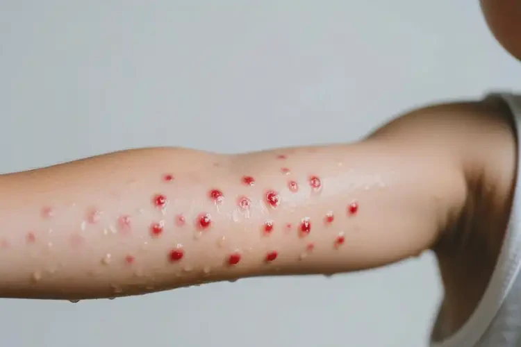 孩子手臂上出現(xiàn)濕疹不管它會自己好嗎(圖2)