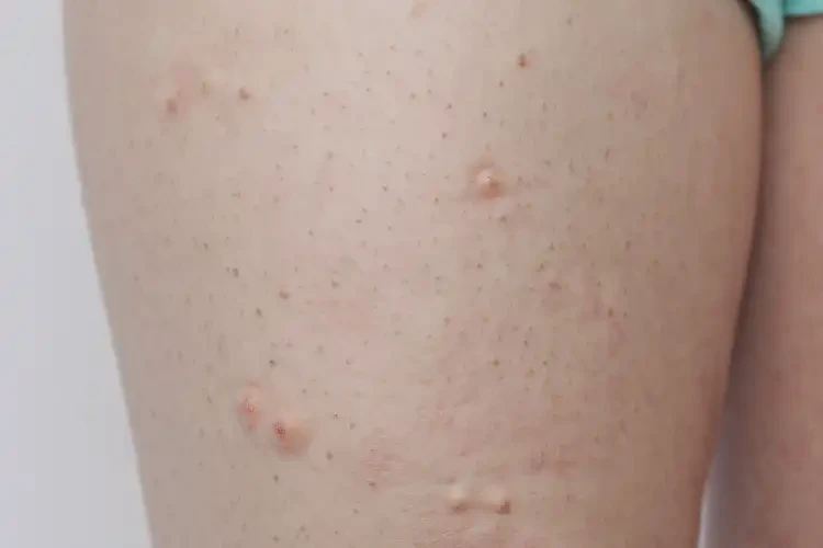 小孩大腿出濕疹可不可以徹底自愈(圖4)