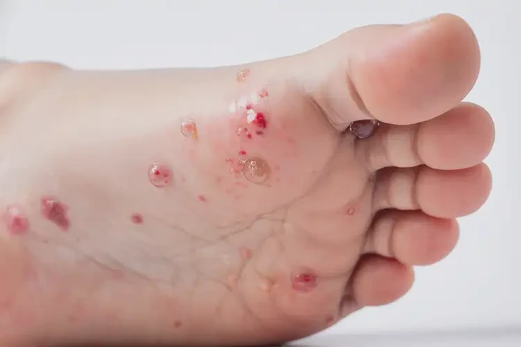 青少年腳上經(jīng)常長(zhǎng)濕疹不管它會(huì)自己好嗎(圖3)