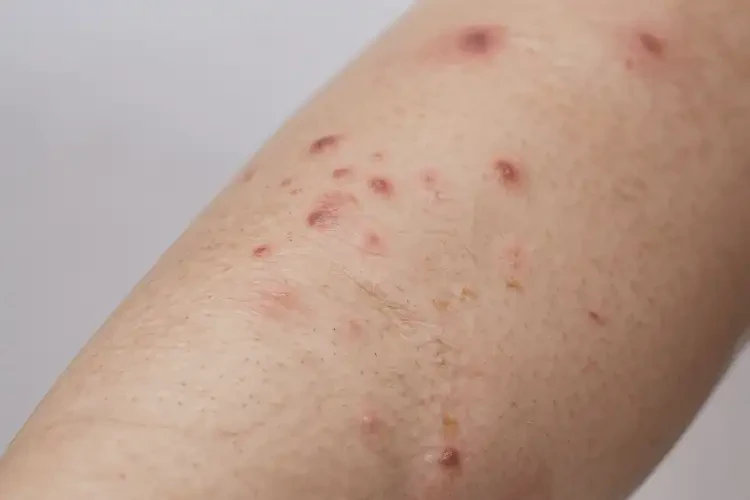 女人大腿上經(jīng)常長(zhǎng)濕疹治療方法(圖4)