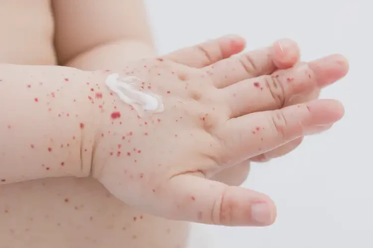 兒童手上出濕疹能夠徹底治愈嗎(圖3)