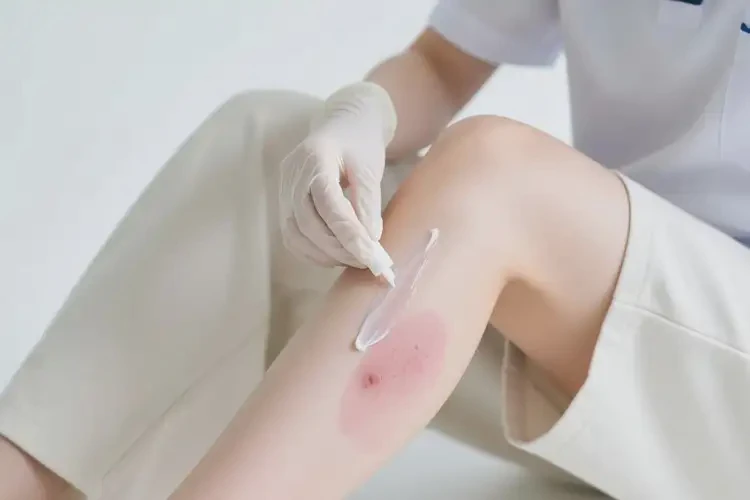 大學生大腿上經(jīng)常長濕疹能徹底自愈嗎(圖4)