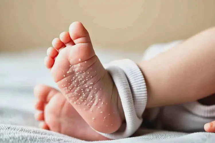 孩子腳上偶爾起濕疹可不可以徹底自愈(圖4)