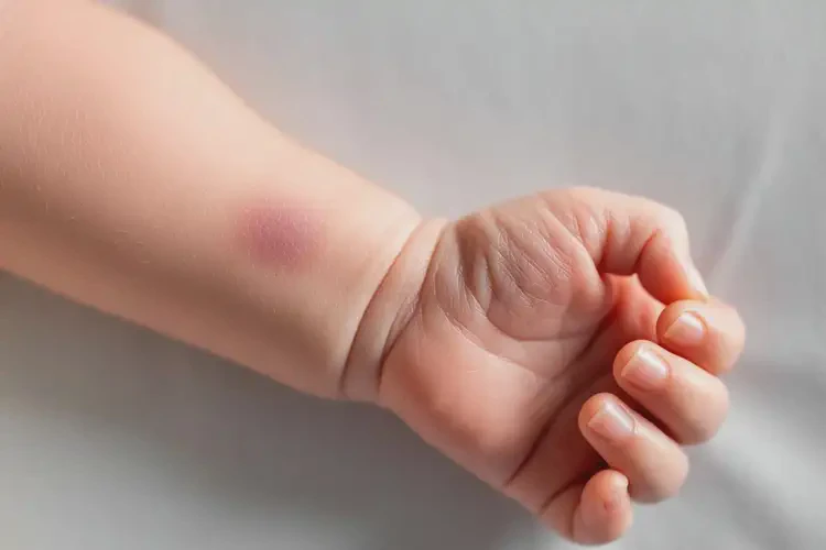新生儿手臂上有湿疹可不可以彻底自愈(图1)