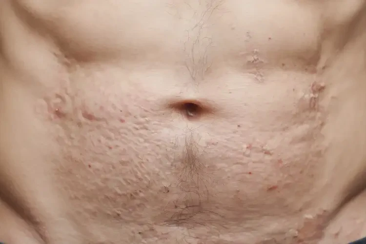 男性肚子上偶爾起濕疹不管它會(huì)自己自愈嗎(圖2)