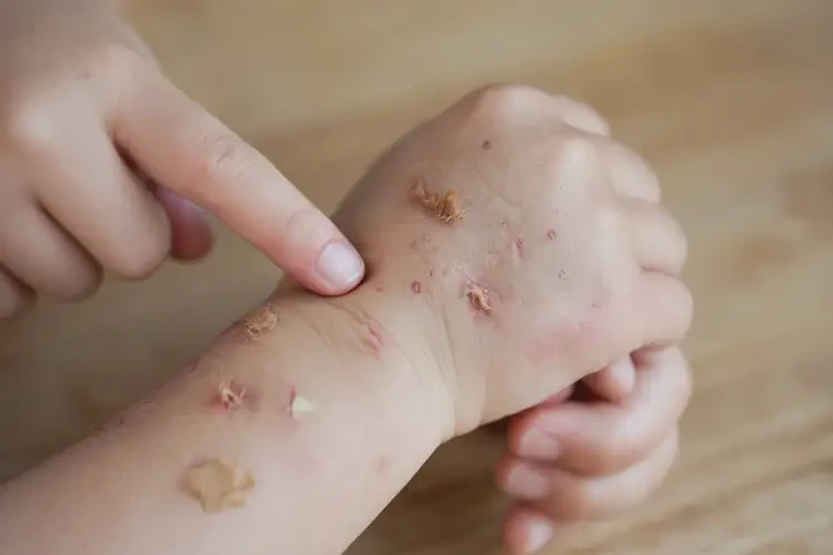 少儿手上有湿疹可以彻底自愈吗(图3)