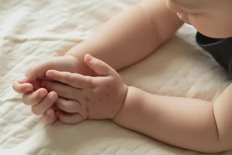 幼兒全身起濕疹不管它會(huì)自己好嗎(圖3)