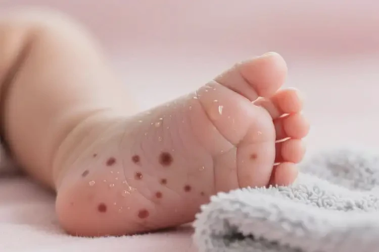嬰兒腳上長濕疹不管它會自己好嗎(圖3)