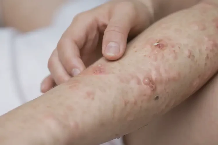 產(chǎn)婦手臂上長(zhǎng)濕疹可以徹底自愈嗎(圖4)