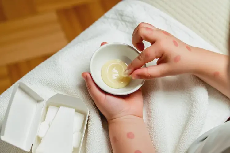 幼兒手上經(jīng)常起濕疹能夠徹底治愈嗎(圖3)