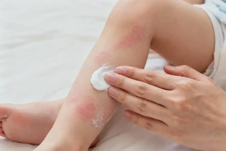 幼兒小腿有濕疹不管它會自己自愈嗎(圖2)