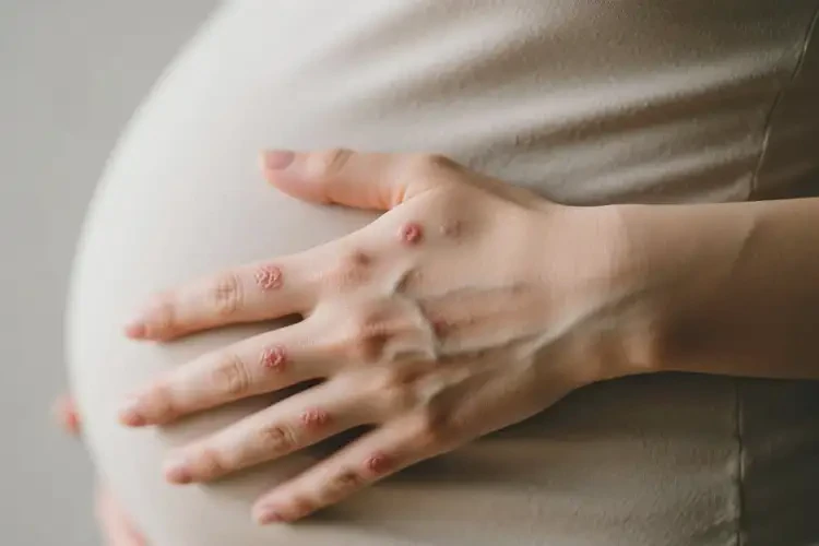 孕婦手上偶爾長(zhǎng)濕疹不管它會(huì)自己好嗎(圖4)