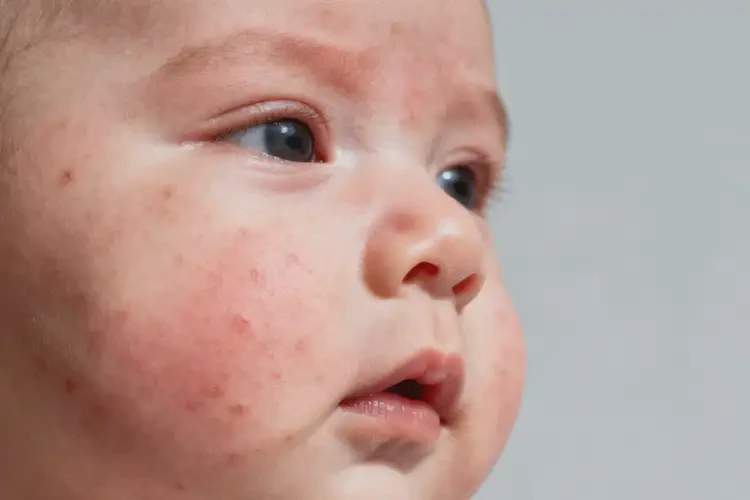 新生兒臉上出濕疹可以徹底自愈嗎(圖4)