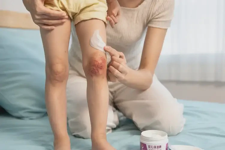 幼兒大腿經(jīng)常起濕疹能徹底自愈嗎(圖3)
